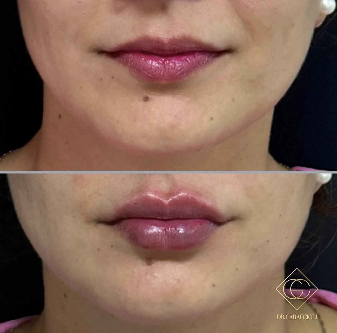 Resultado antes y después en Caraccioli Clinic