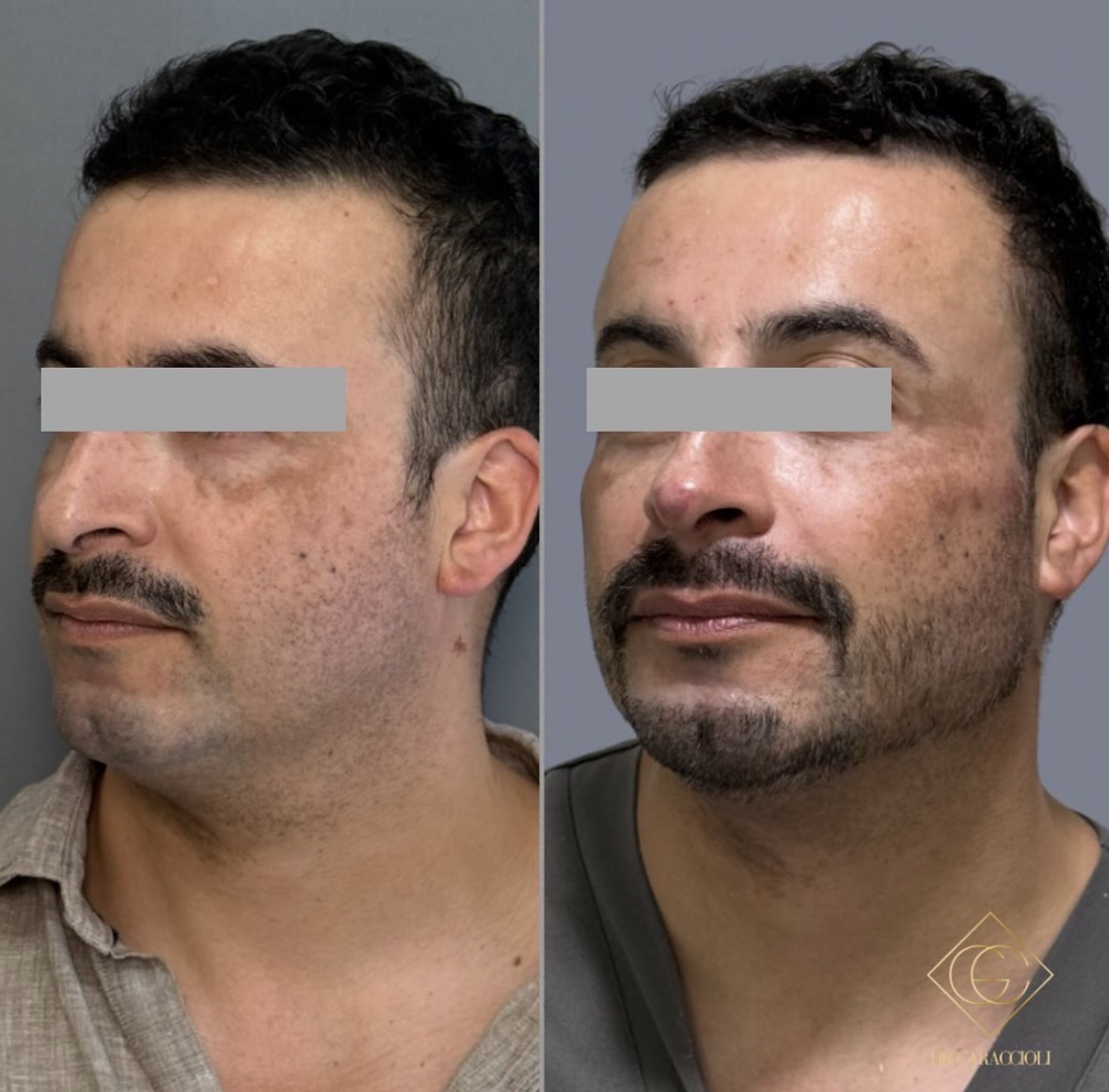 Resultado antes y después en Caraccioli Clinic