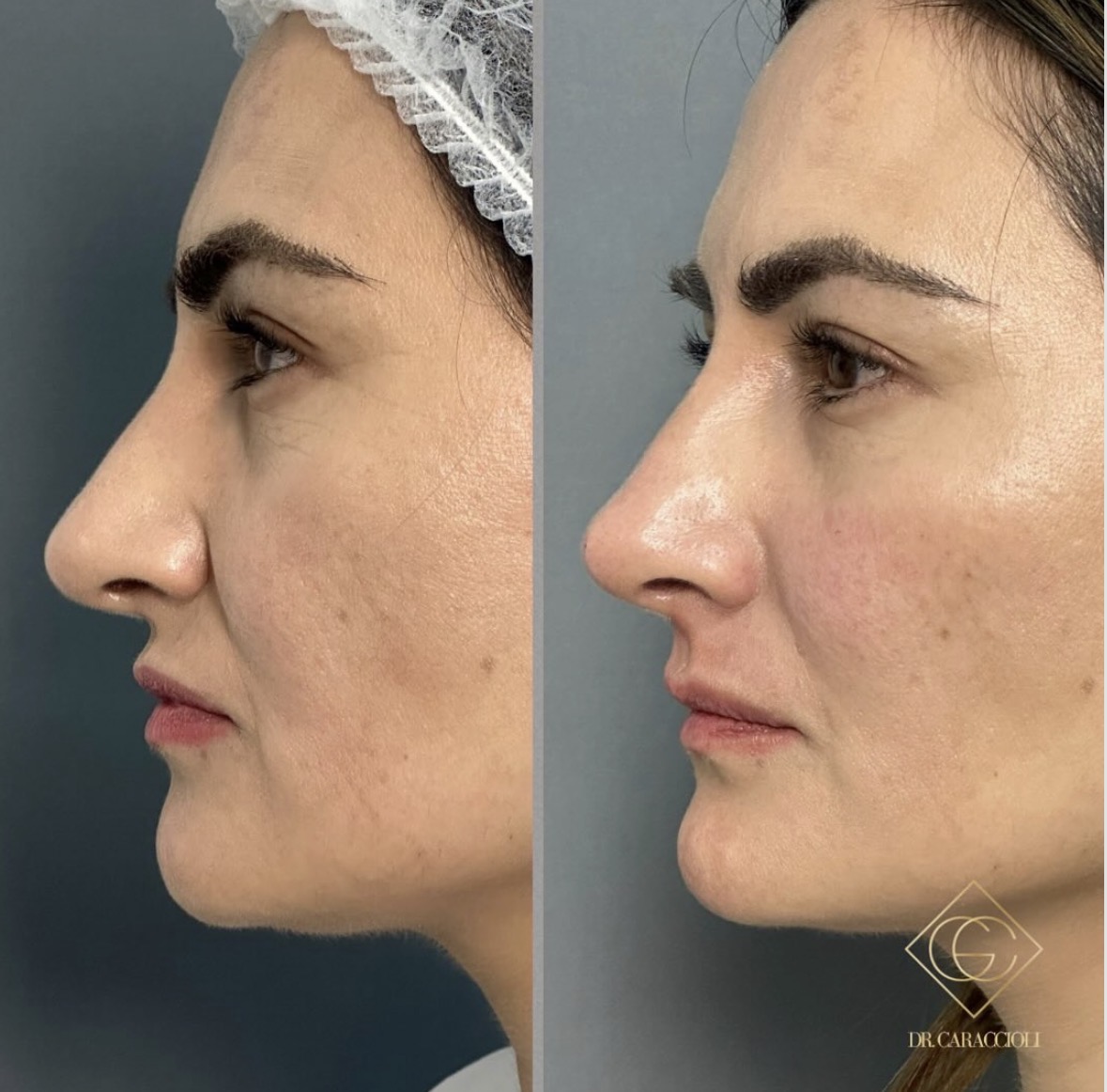Resultado antes y después en Caraccioli Clinic