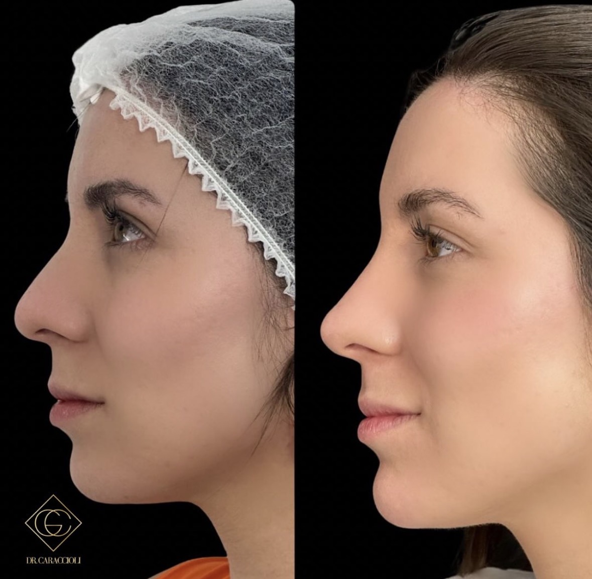 Resultado antes y después en Caraccioli Clinic