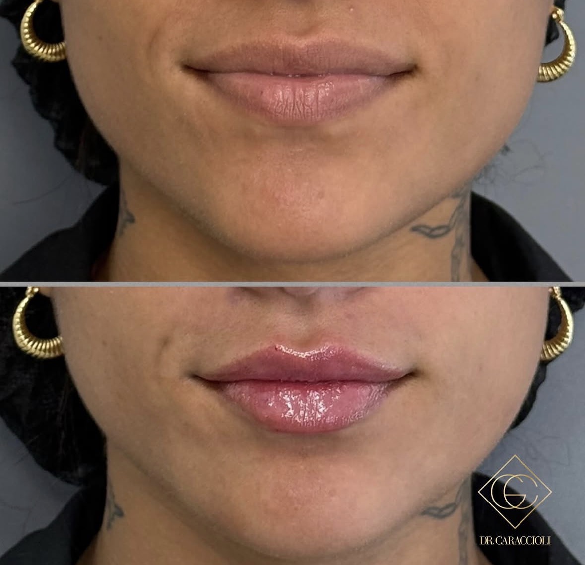 Resultado antes y después en Caraccioli Clinic