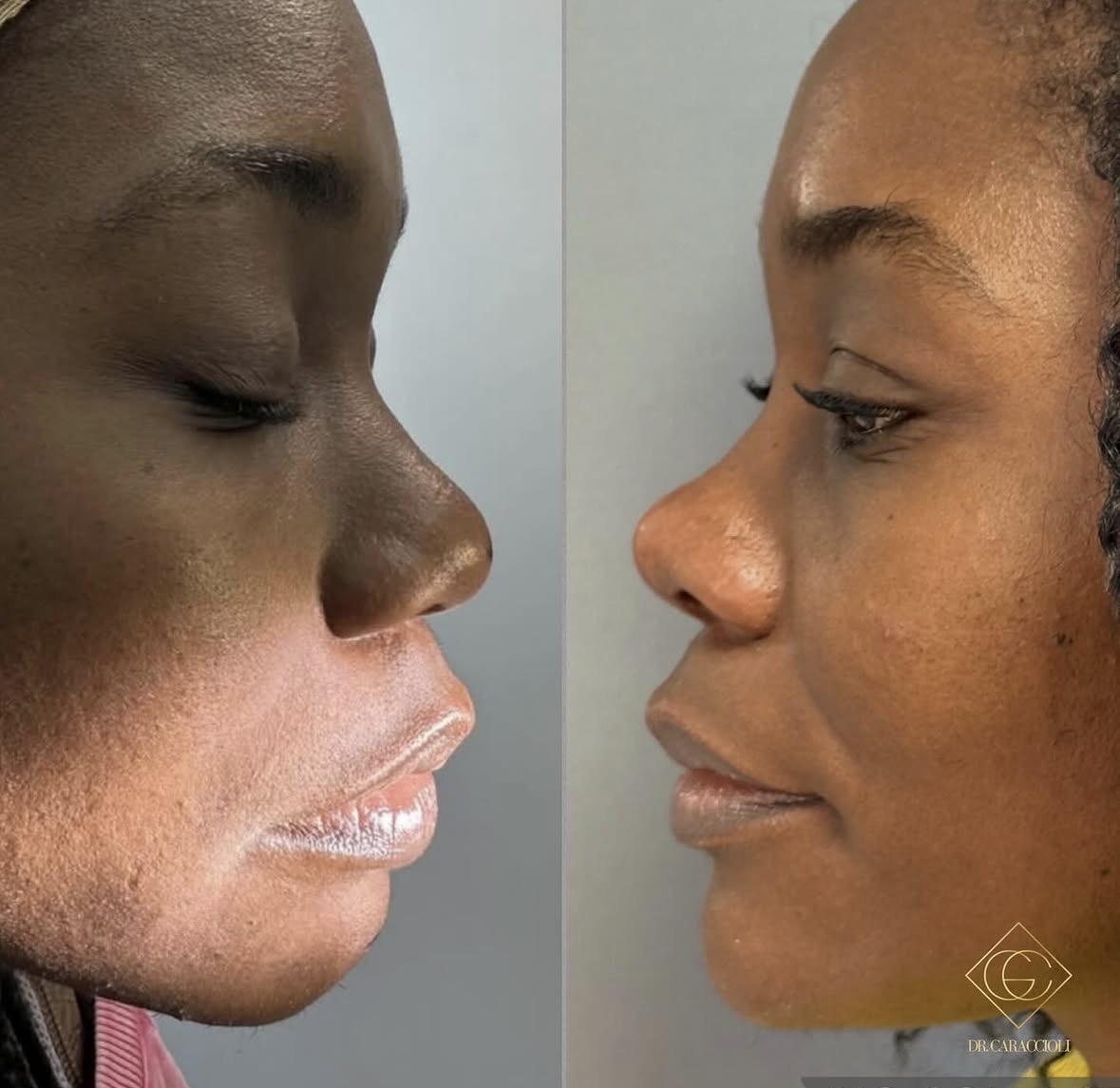 Resultado antes y después en Caraccioli Clinic