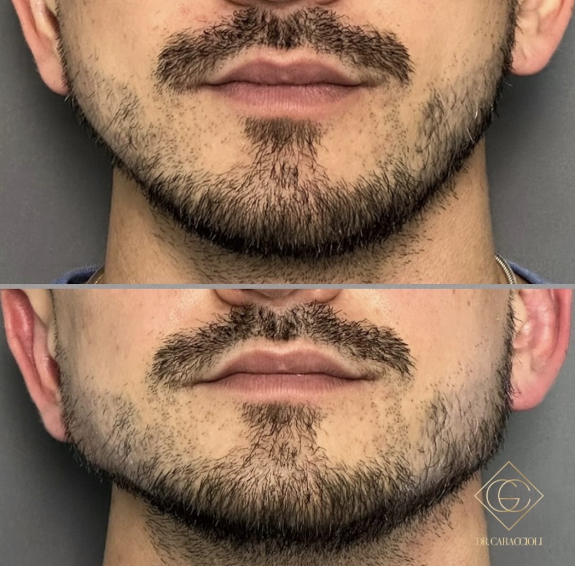 Resultado antes y después en Caraccioli Clinic