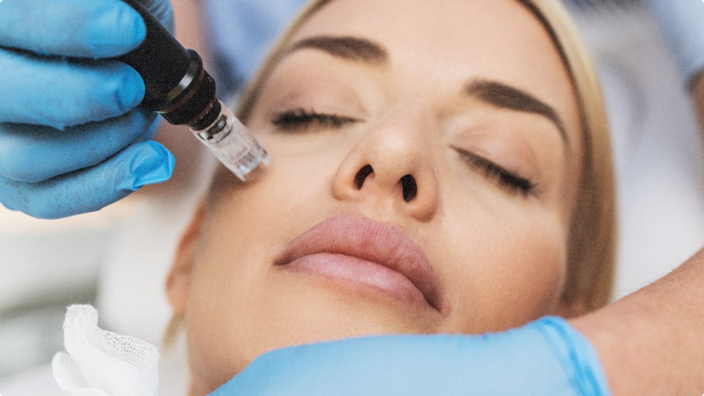 PRF Microneedling procedure