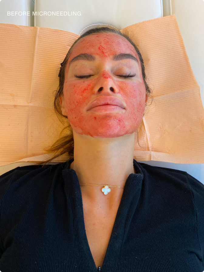 Before microneedling