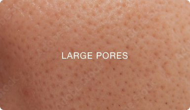 LARGE PORES