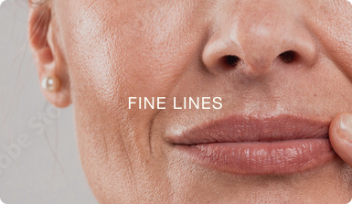 FINE LINES