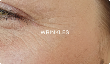 WRINKLES