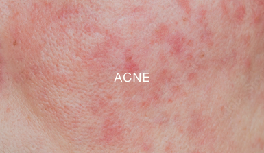 ACNE