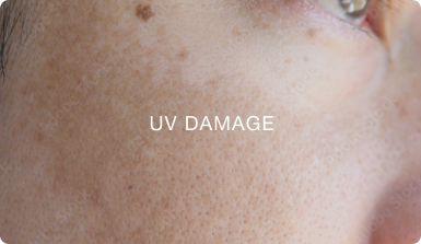 UV DAMAGE