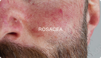 ROSACEA