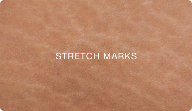 STRETCH MARKS