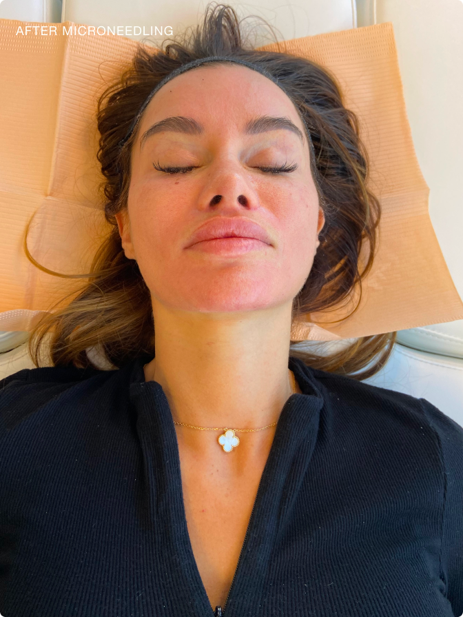 After microneedling