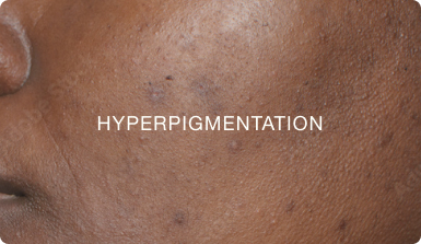 HYPERPIGMENTATION