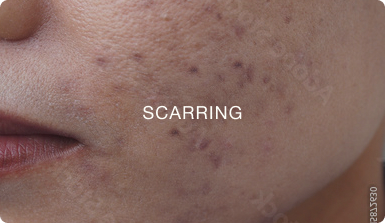 SCARRING