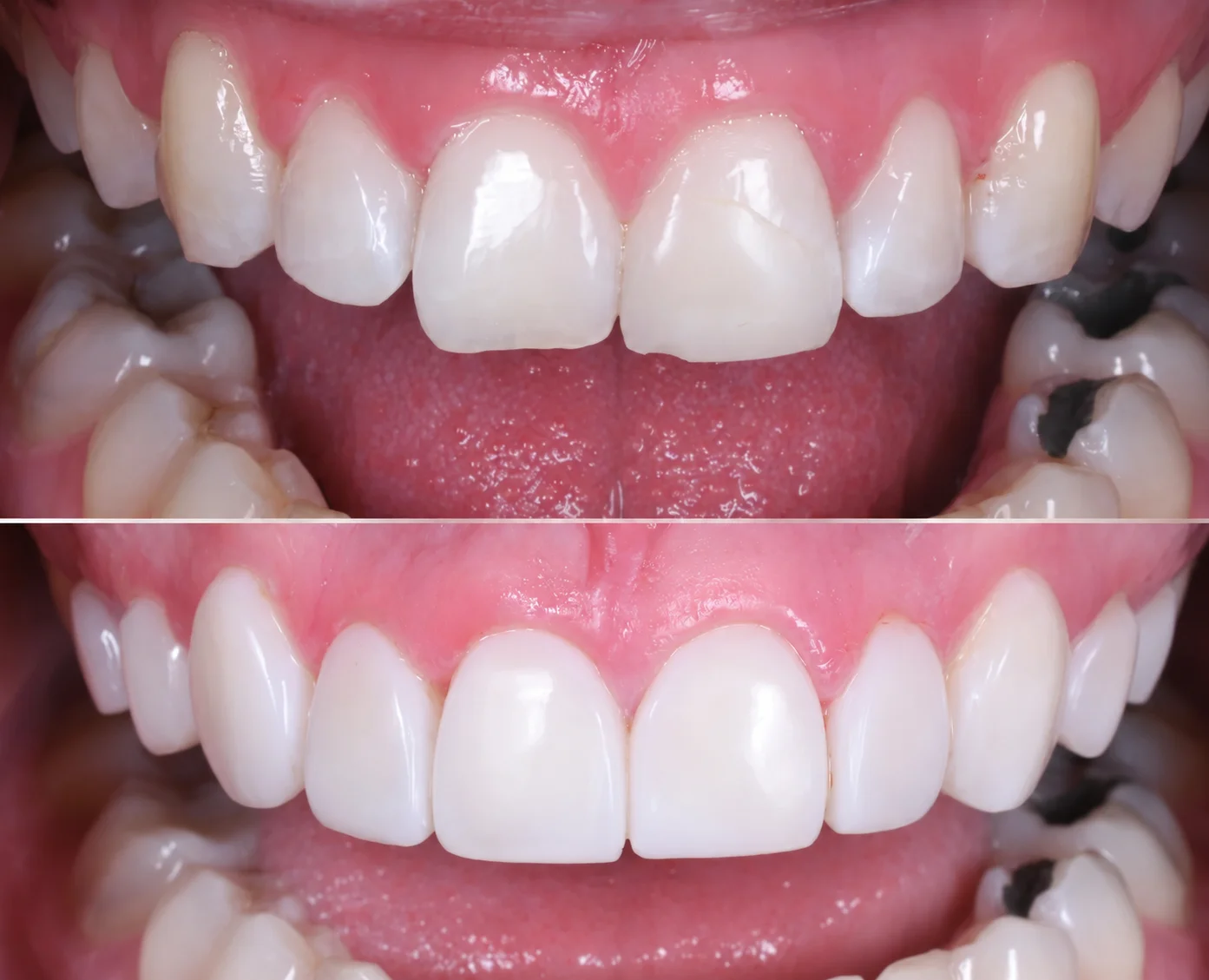 Composite bonding before and after smile result