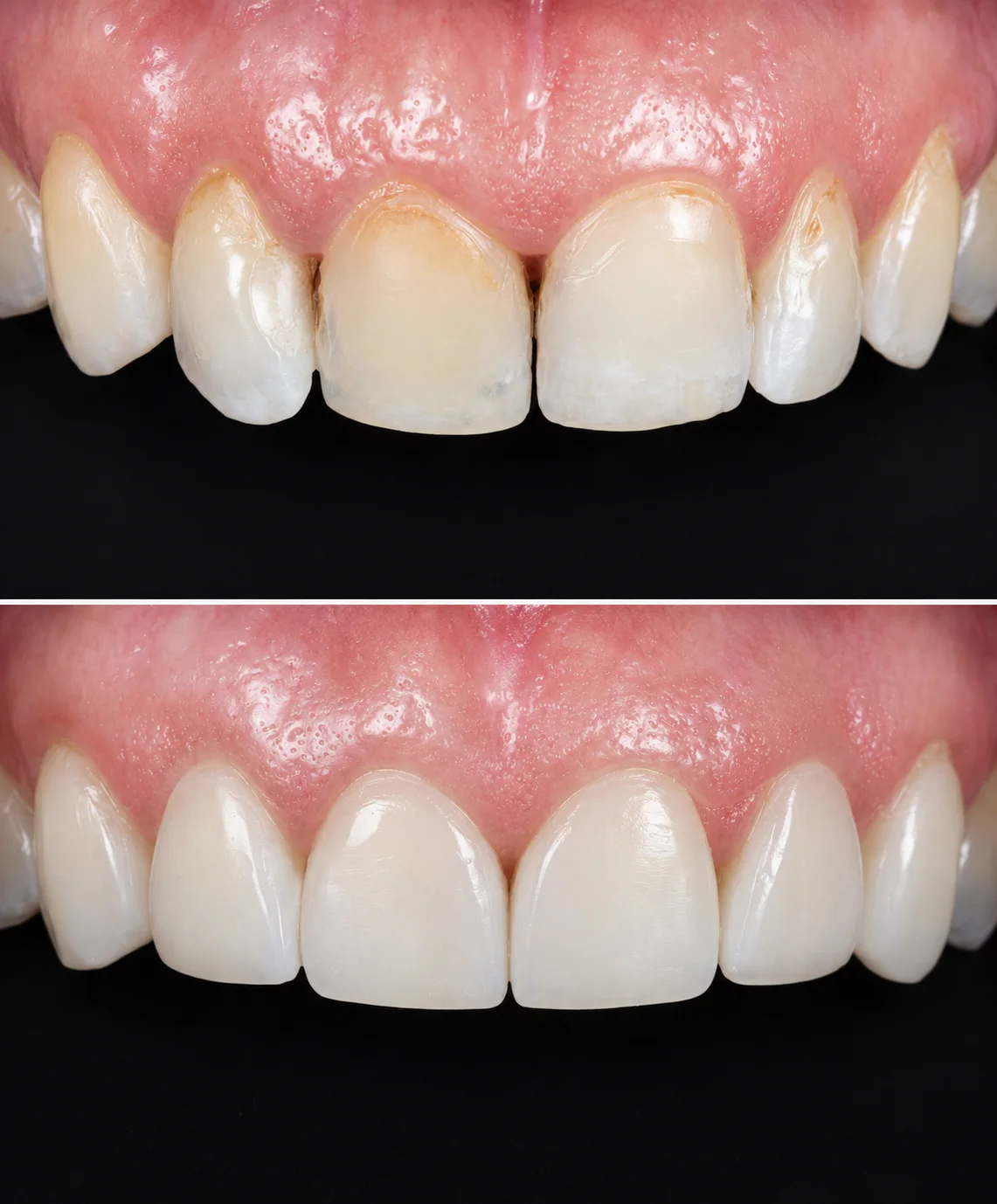 Teeth whitening result by Dr Uzair Janjua