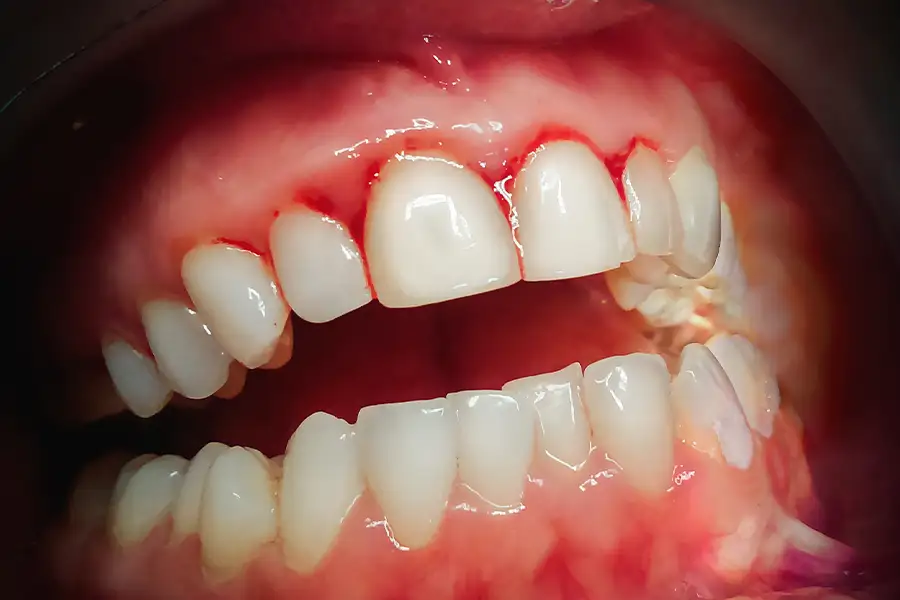Advanced gum disease symptoms