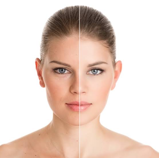 Skin rejuvenation