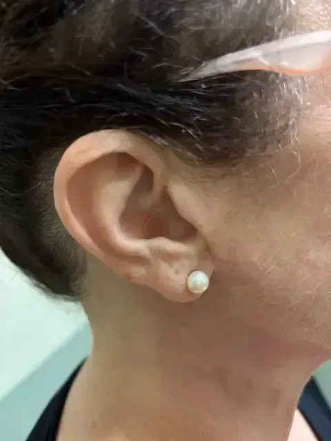 Close-up of a patient's outer ear.
