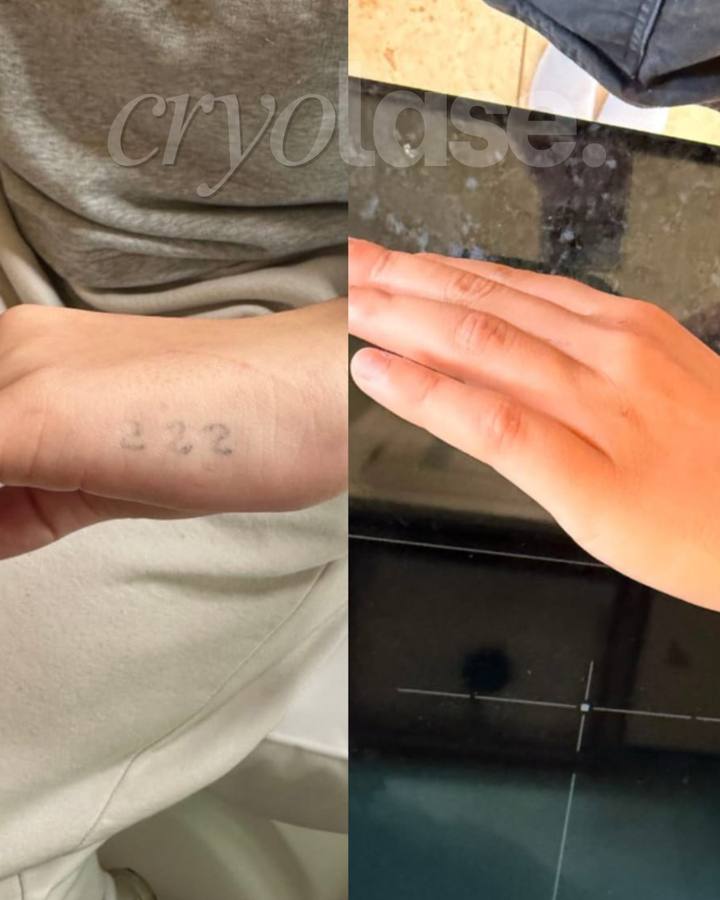 Hand tattoo before and after