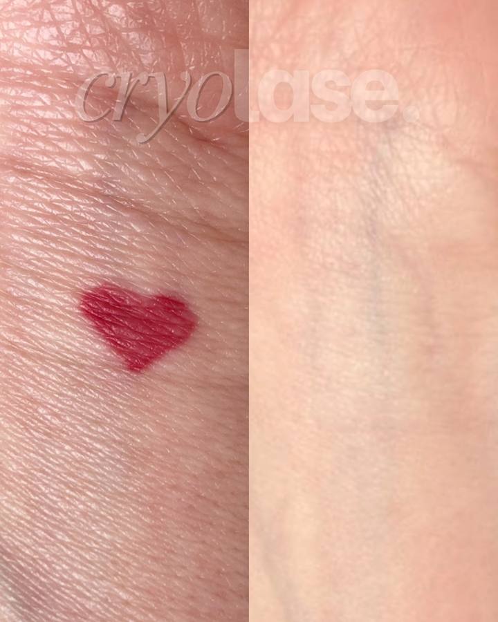 Red heart tattoo before and after
