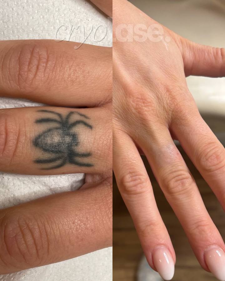 Spider tattoo before and after Cryolase laser removal
