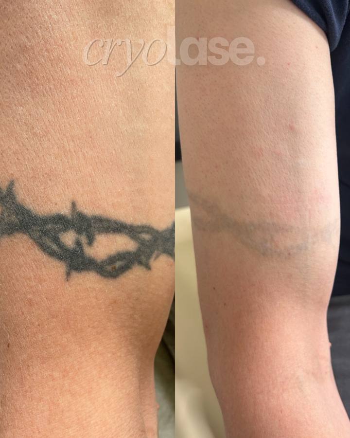 Armband tattoo before and after