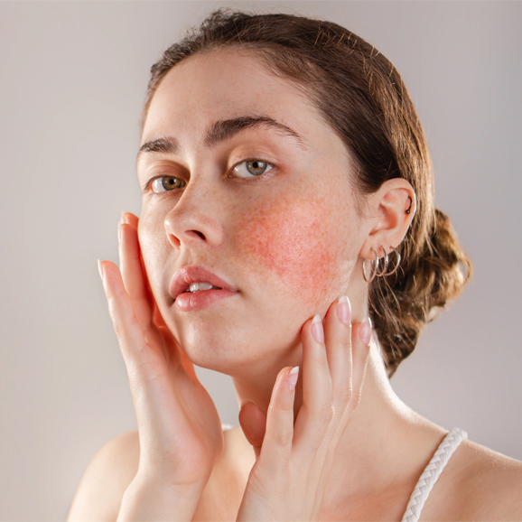 Sensitive and rosacea skin care at White Pearl Medical Spa