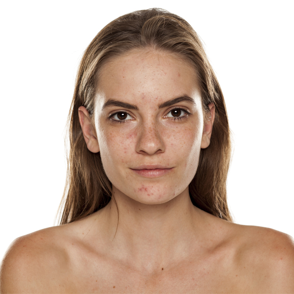 Melasma treatment at White Pearl Medical Spa