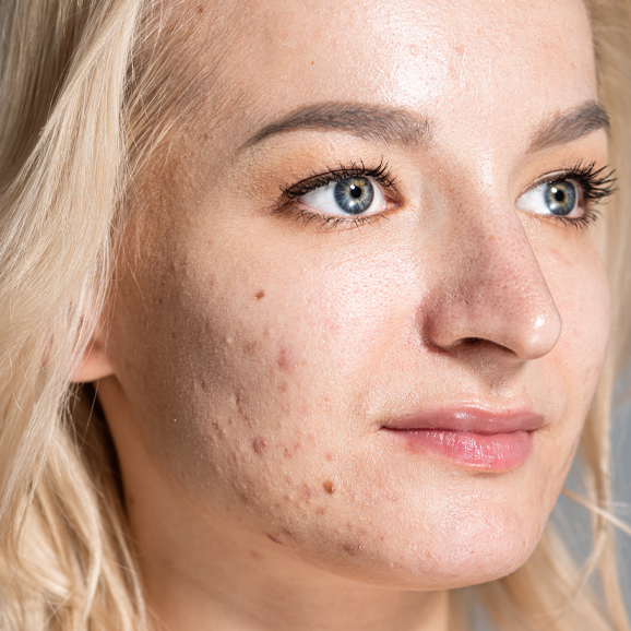 Acne treatment at White Pearl Medical Spa