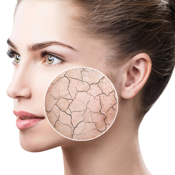Dry and dehydrated skin treatment at White Pearl Medical Spa