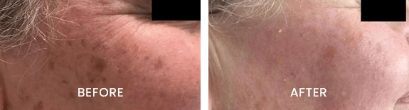 Before and after result at White Pearl Medical Spa