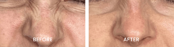 Before and after result at White Pearl Medical Spa