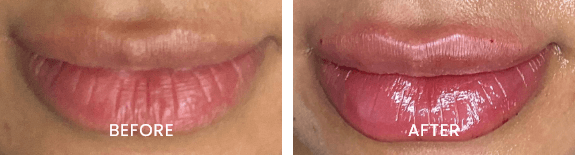 Before and after result at White Pearl Medical Spa