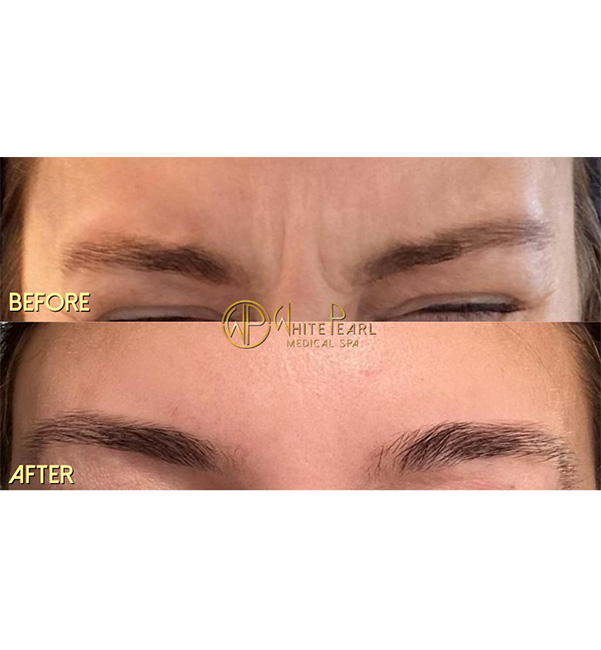 Botox before and after result, frown lines