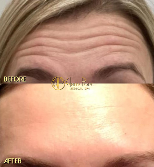 Botox before and after result, crow's feet
