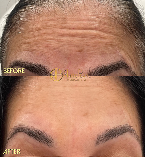 Botox before and after result at White Pearl Medical Spa