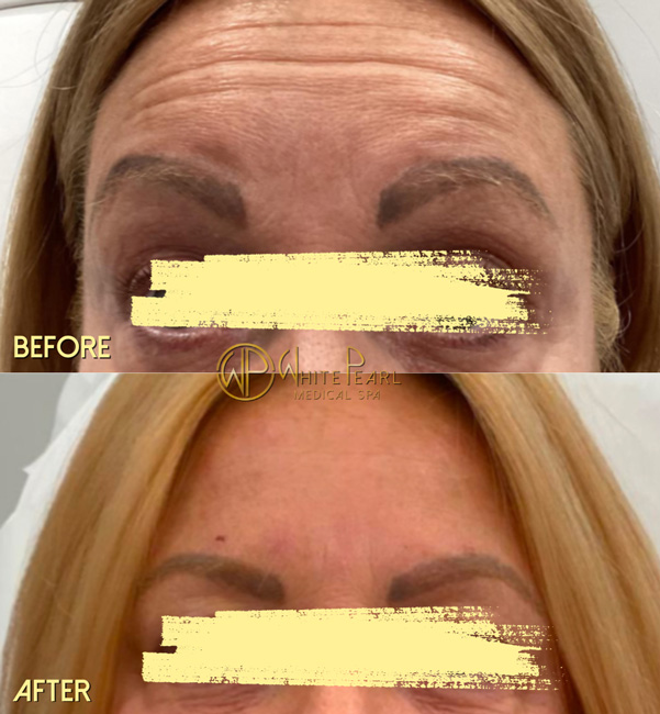 Botox before and after result, forehead lines