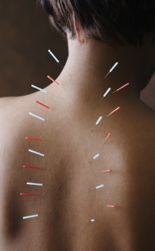 Acupuncture needles treatment close up
