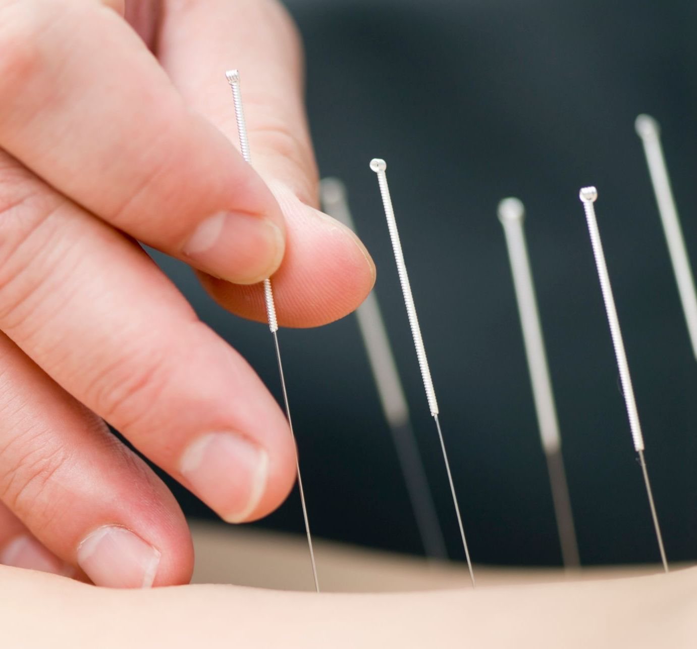 Acupuncture needles being placed