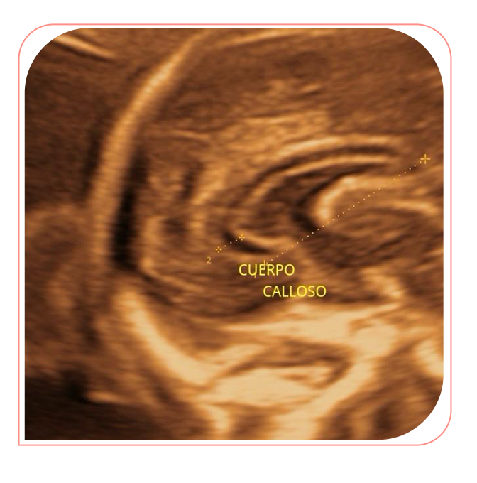 Neurosonografía fetal avanzada