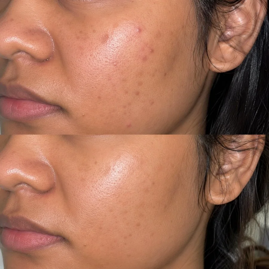 Cheek before and after: breakouts settled
