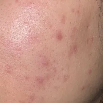 Close-up of acne breakouts on a cheek