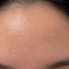 Close-up of small bumps and clogged pores on a forehead