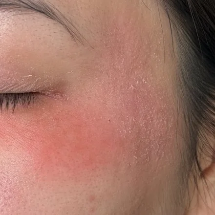 Close-up of red, flaky skin beside the eye