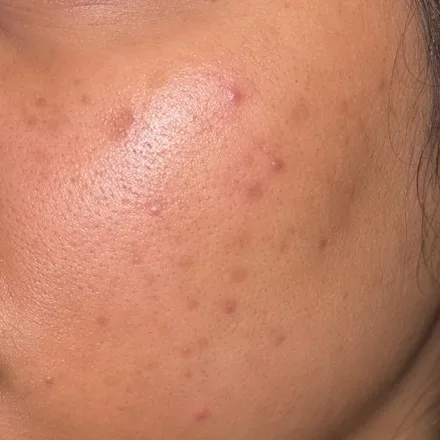 Close-up of dark acne marks on a cheek
