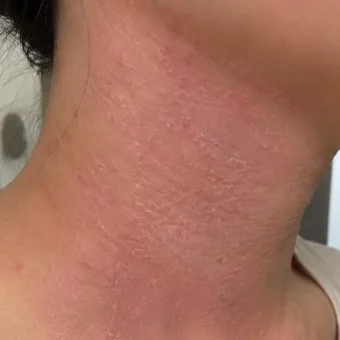 Close-up of an eczema patch on the neck