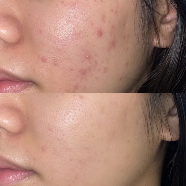 Lisa's cheek, before and after: acne settled