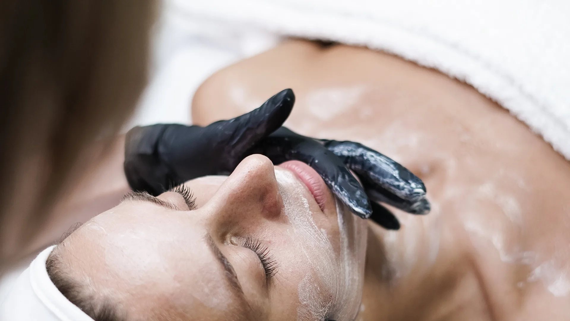 Radiofrequency microneedling treatment on the face